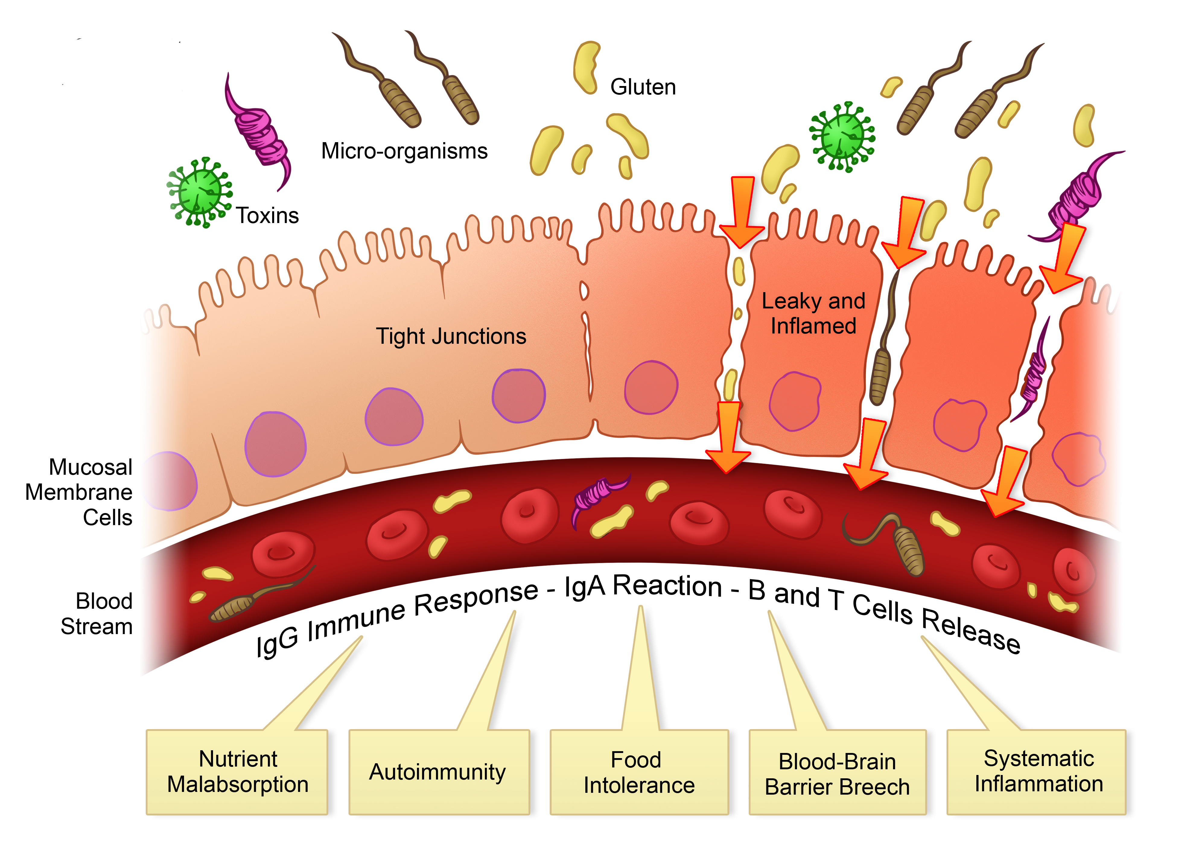 SINDROME DELL’INTESTINO PERMEABILE